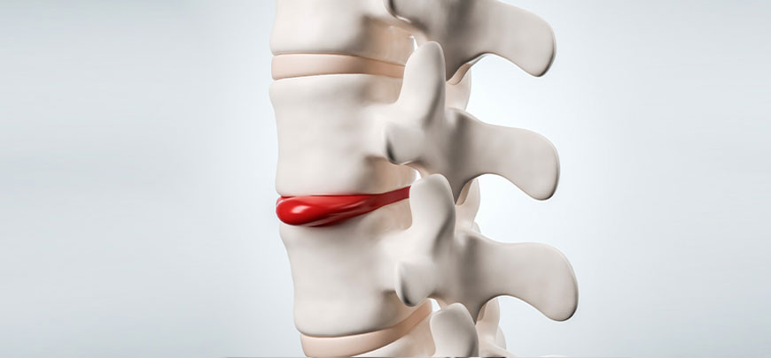 patient receiving herniated disc in Sacramento