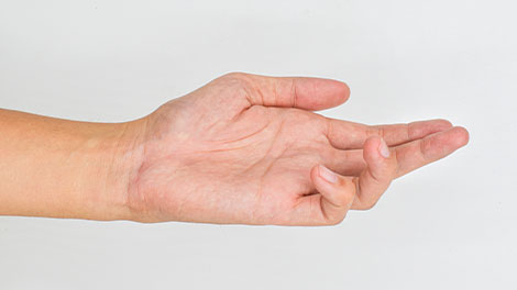 patient requiring dupuytren contracture treatment in Sacramento