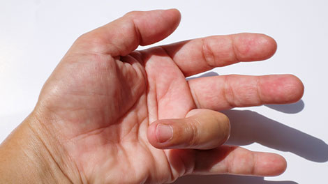 patient requiring trigger finger treatment in Sacramento